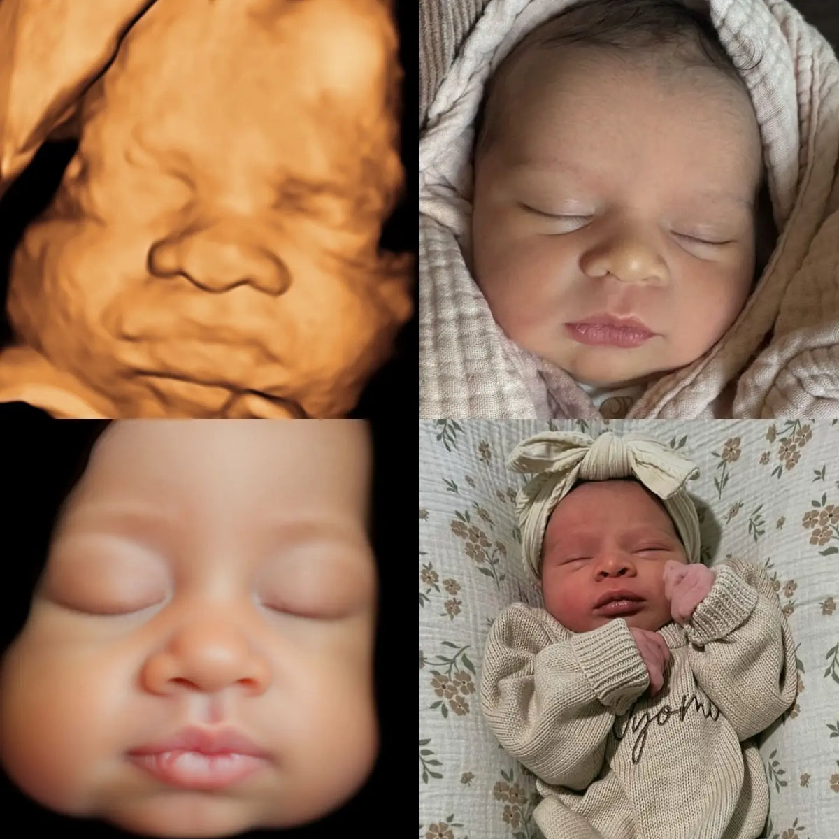 Detailed Ultrasound 8K Enhancement